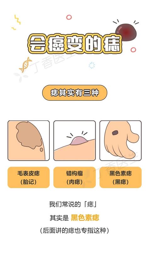 乳房長痣|痣也可能会癌变！长在 3 个地方要注意